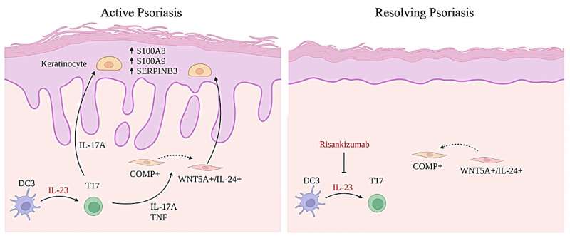 Diagram showing the early effects of therapeutic IL-23 inhibition. Left: in lesional psoriasis skin, IL-23 drives the differentiation of T17 cells. Right: following IL-23 blockade, T17 cell differentiation and IL-17 production are inhibited, while WNT5A+/IL24+ fibroblasts revert to their COMP+ state. As a result of diminished IL-17 and IL-24 production, keratinocyte homeostasis is re-established. Credit: Nature Communications (2024). DOI: 10.1038/s41467-024-44994-w