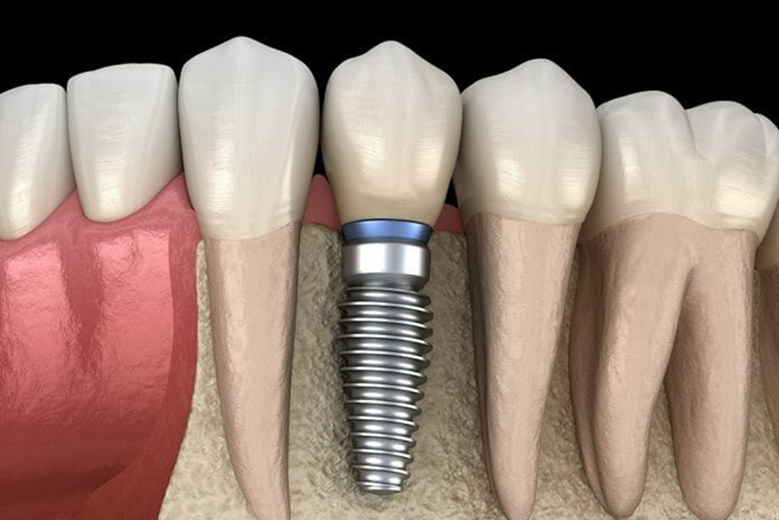 How to Recognize the Most Common Complications of Dental Implants