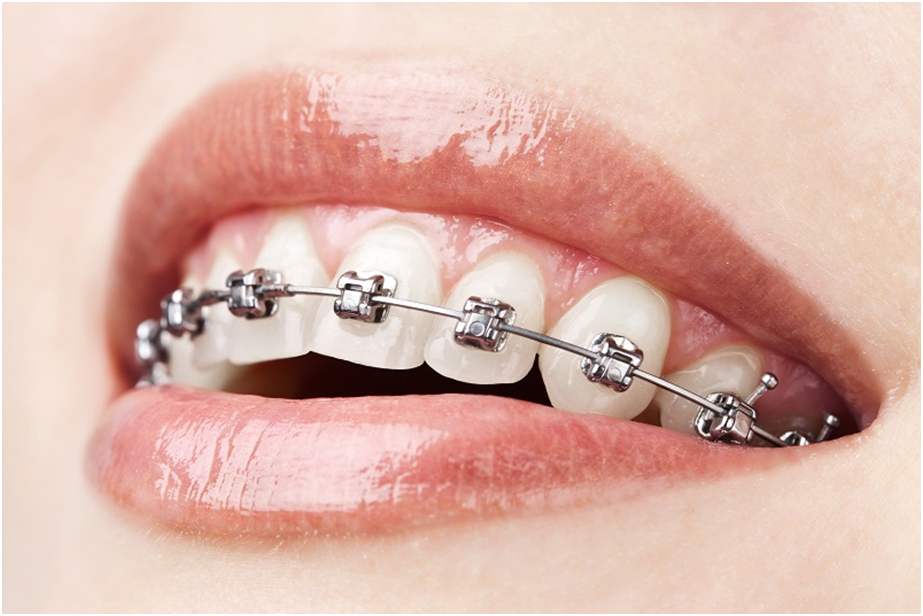 Invisalign London vs traditional braces for straightening your teeth 