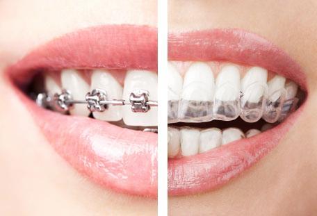 Everything You Need To Know Considering Invisalign 