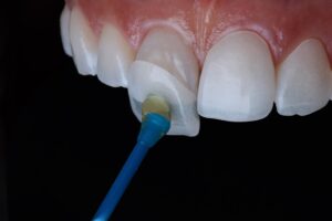 4 Things You need To know about Dental Veneers 