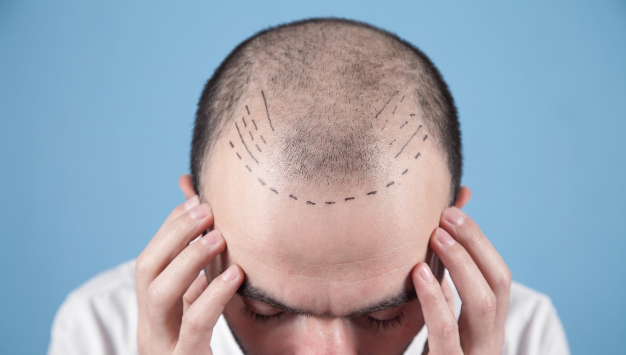 Hair Transplant: The New Male ‘Must-Have’ Procedure – Medical Travel Market