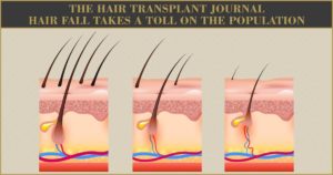 The-Hair-Transplant-Journal-Hair-Fall-takes-a-toll-on-the-population-300x158