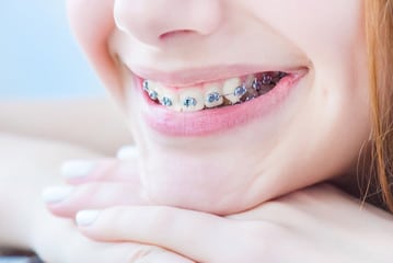 4 Prevention Tips to Avoid Bacteria While Wearing Braces