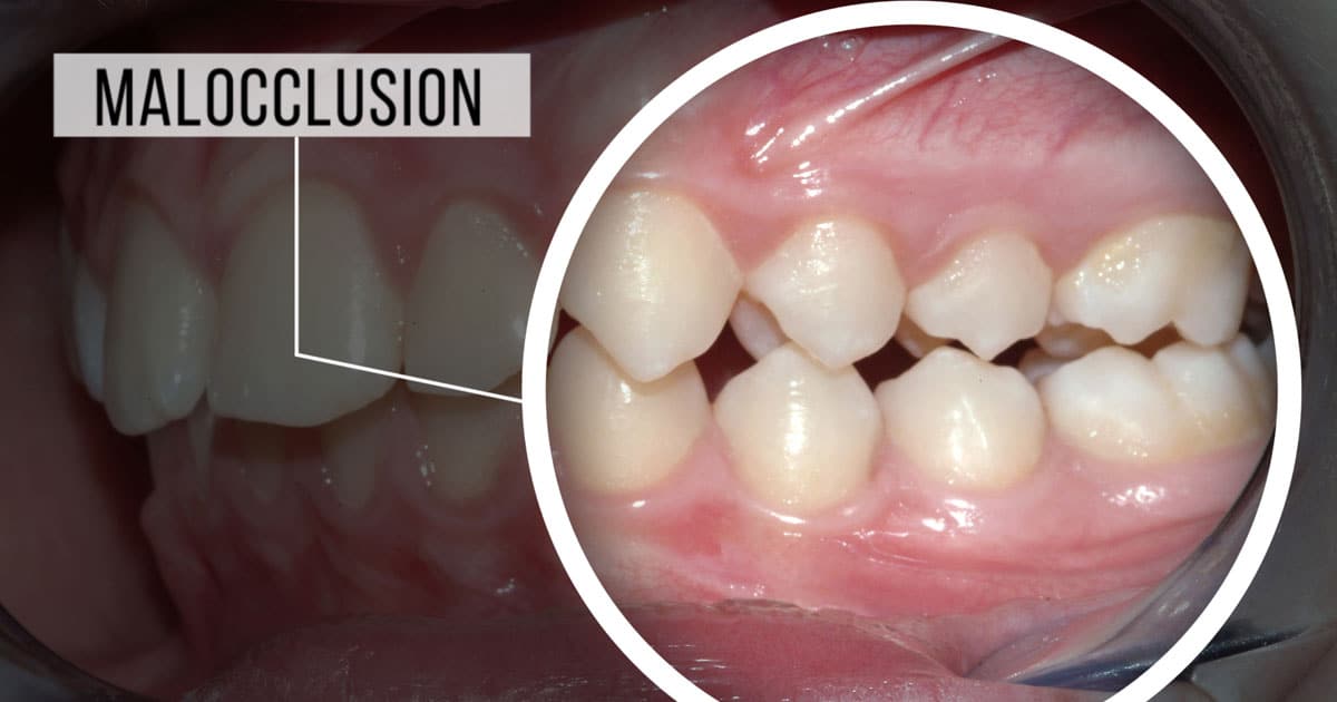 Malocclusion : Causes, Symptoms, Classification and Treatment