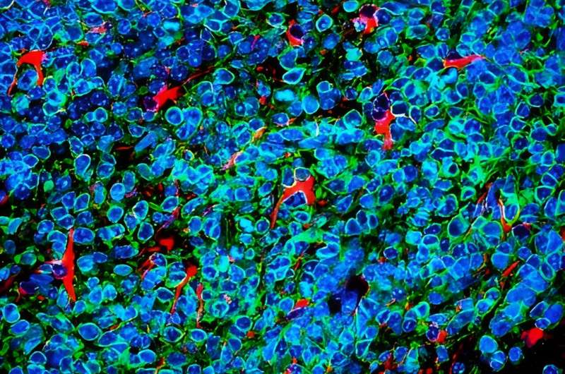 Lung cancer cells covertly thrive in brain under guise of protection, Stanford Medicine study finds