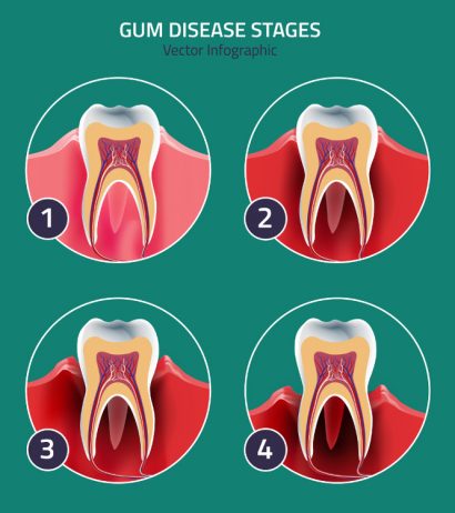 World Dental Federation Aims to Take Bite out of Gum Disease