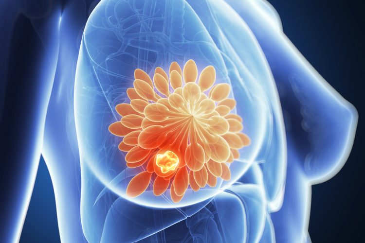 blue torso of a woman with a breast cancer tumour highlighted in glowing red