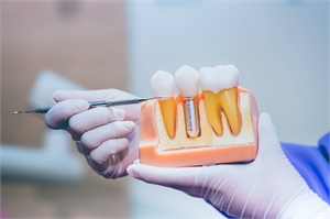 Are You A Good Candidate For Dental Implants?