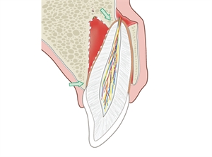 Lateral Luxation of tooth - prognosis, management and treatment