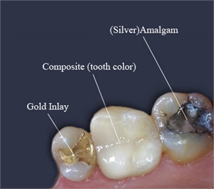 How soon can I eat after I've had a tooth filling done?