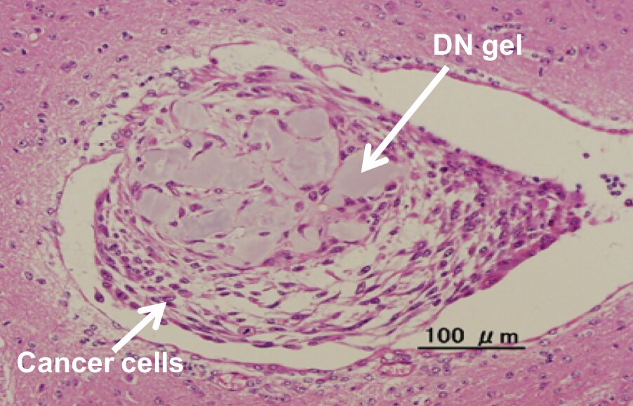 Uprooting cancer: Hydrogel rapidly reverts cancer cells back to cancer stem cells