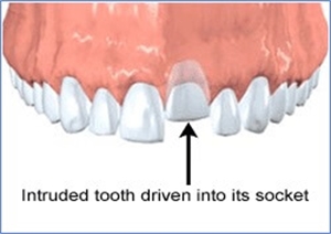 What is the treatment of tooth intrusion?