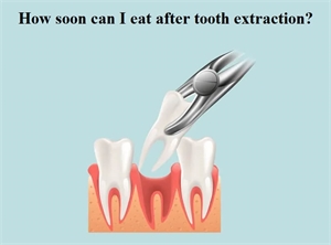 How soon can I eat after tooth extraction? 