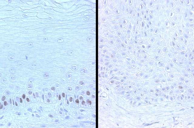 Images showing the difference in the prevalence of p53 in the oral tissue of a 28-year-old (left) and a 74-year-old (right). Credit: Dr. Reuben Kim