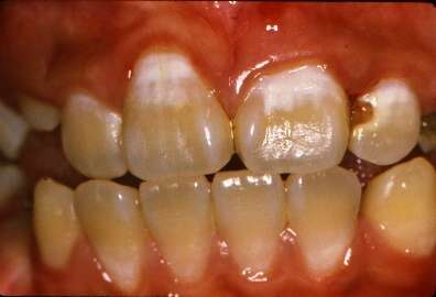 The white patches are signs of early decay that can be stopped and reversed before they become cavities (brown patch on tooth on the right). Credit: University of Sydney