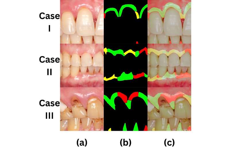 Three cases illustrating dentist's visual examination (b) and AI's detection (c) of gum problems (a) Intraoral photograph (b) Health status labeled by a calibrated dentist (green=healthy, red=diseased, yellow=questionable) (c) AI detection results. Credit: Faculty of Dentistry, HKU