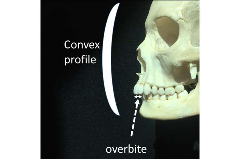 Slender faces are also associated with overbites and left-handedness. Credit: Philippe Hujoel