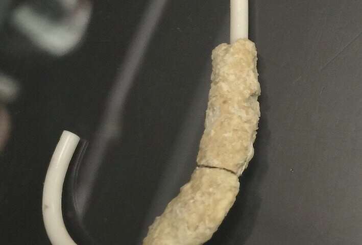 Recovered ureteral stent encrusted with minerals and bacteria. Credit: Lawson Health Research Institute