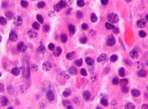 Micrograph of a plasmacytoma, the histologic correlate of multiple myeloma. H&E stain. Credit: Wikipedia/CC BY-SA 3.0