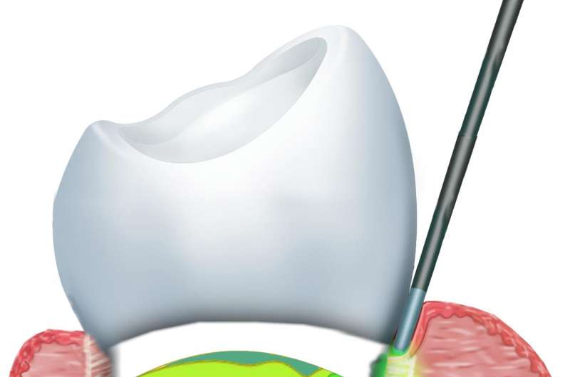 The cylindrical geometry of the periodontal ligament. Credit: Lou Reinisch/NYIT