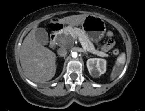 Axial CT image with i.v. contrast. Macrocystic adenocarcinoma of the pancreatic head. Credit: public domain