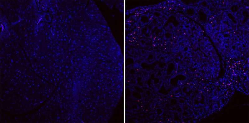 Two sections of pancreatic tissue, in blue. The one on the right is taken from a mouse with pancreatic cancer. The pink dots are fungi seen only in the pancreas with cancer. Credit: Nyu School Of Medicine