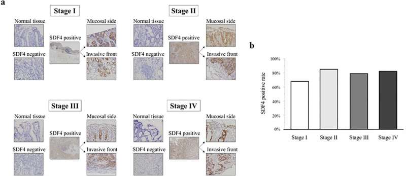 (a) Representative immunohistochemical staining of SDF4 in normal gastric and GC tissues. The five panels at each stage show normal gastric tissue, negative control GC tissue, positively stained GC tissue, and enlargements showing the mucosal side and invasive front. (b) Proportion of tumors at each stage staining positively for SDF4. Credit: Scientific Reports (2023). DOI: 10.1038/s41598-023-42201-2