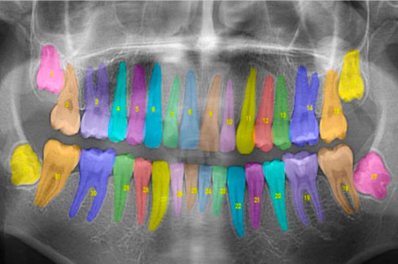 The MIT alumni-founded Overjet uses artificial intelligence to annotate dental X-rays for dentists. Credit: Overjet