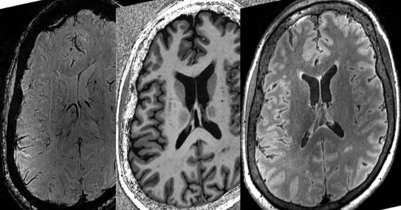 Three 7T MRI scans. Credit: Rob Bartha