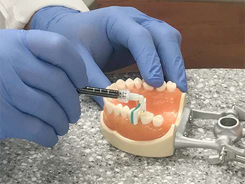 This treatment works only in between teeth or on smooth surfaces where there are small cavities. Credit: University of Alabama at Birmingham