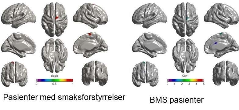 Brain scans showing pathology in the pain matrix in patients with "burning mouth syndrome" (BMS). Credit: University of Oslo