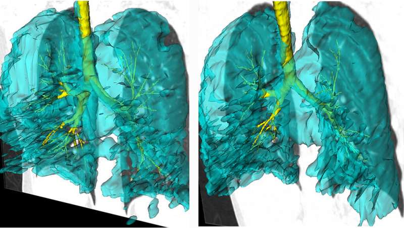 Researchers used a specialized MRI techniques to visualize the lungs of twins with asthma. While the twins are non-identical, the researchers found that they actually had identical ventilation defects in the same upper left lung segment, which stayed the same over the duration of the seven year study. Credit: Schulich Medicine &amp; Dentistry