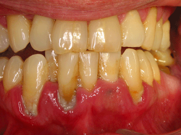 Plaque scraped from gums can be used to analyze disease. Credit: H. Tenenbaum