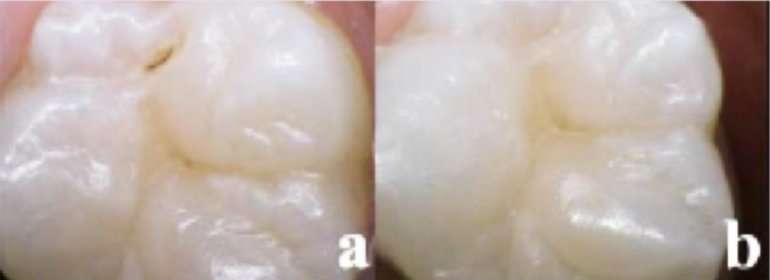 Laser treatment combined with fluoride varnish can remineralize teeth over time, essentially reversing damange already done. This image shows a molar before treatment (left) and six-months after laser treatment and fluoride varnish.  Credit: University of California, San Francisco