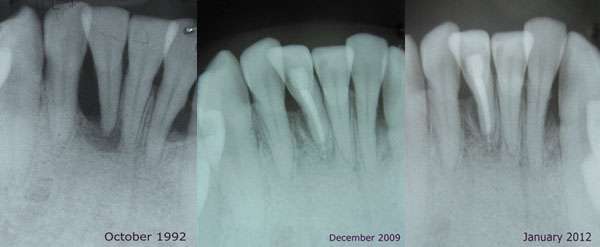 Patient with severe periodontitis improves with microbial treatments and one surgery. Credit: H. Tenenbaum