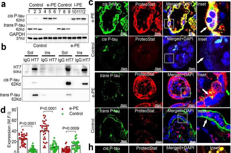 Robust cis P-tau expression in PE placenta and trophoblast cells exposed to hypoxia. a Immunoblots of placental protein extracts from gestational age-matched control (control; n = 3), early onset PE (e-PE; n = 3), and late onset PE (l-PE; n = 3) probed for cis and trans P-tau. b Sarkosyl soluble and insoluble fractions of placental extracts from age-matched controls (n = 7) and early-onset PE (e-PE; n = 7) were immunoprecipitated with HT7 (t-tau) and IgG antibodies before immunoblots against cis and trans P-tau. c Representative confocal images of human placental tissue sections from e-PE and age match control for double immunofluorescence with cis P-tau (green), trans P-tau (green), and ProteoStat (red). Inserts are magnified images of boxed areas. Cytotrophoblasts: complete arrow; syncytiotrophoblasts: incomplete arrows. Scale bar: 50 μm. Mean fluorescence intensity (MFI) quantification of cis P-tau, trans P-tau and ProteoStat positive protein aggregates in e-PE (d) and l-PE (e) placental sections (e-PE, n = 17; control, n = 16; l-PE, n = 19; control, n = 21, total 33–40 placental sections were analyzed per condition, two way ANOVA followed by Bonferroni’s post hoc test; mean±s.e.m. f Pearson’s colocalization coefficient (PCC) for cis P-tau and ProteoStat (left) is higher than for trans P-tau and ProteoStat (right); n = 35. Statistics are represented in the figure derived from two-tailed unpaired t test with Mann Whitney test.; mean±s.e.m. g Age-matched (control) and e-PE placental lysates were treated with (+λ) or without (-λ) lambda phosphatase (Ppase), followed by immunoblot with antibodies identifying early (cis P-tau and trans P-tau) or late (pS396) tau phosphorylation. Loading control was GAPDH. h Hypoxia-reoxygenation (H/R) stress induces robust cis P-tau aggregation. Human primary trophoblast cells were exposed to hypoxia (1% O2) for 72 h followed by 2-3 h incubation in reoxygenation (21% O2) conditions or normoxia environment (21% O2). The merged picture with nuclear DAPI demonstrated co-localization. Inserts were enlargements of boxed portions. Images are representatives of n = 7 independent experiments, scale bar: 50 μm. i Disruption of β-tubulin positive microtubule network due to hypoxia in human primary trophoblast cells. ProteoStat positive protein aggregate puncta accumulated near damaged microtubule structure. Images are representatives of n = 5 independent experiments. Bar: 100 μm. Credit: Nature Communications (2023). DOI: 10.1038/s41467-023-41144-6