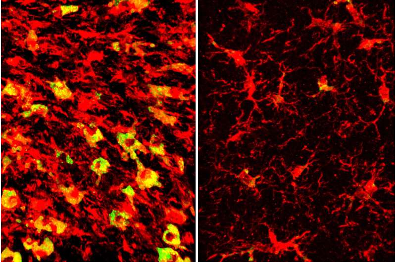 Lowering a form of brain cholesterol reduces Alzheimer's-like damage in mice