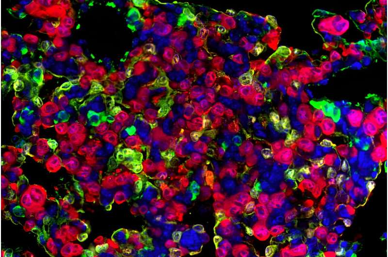 Lung cancer cells' 'memories' suggest new strategy for improving treatment