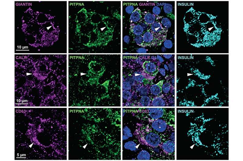 New research sheds light on cause of type 2 diabetes