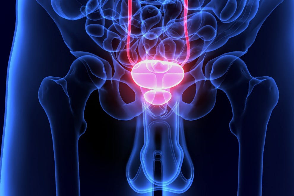 Cáncer de próstata: causas, síntomas y prevención
