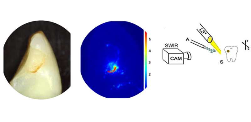 Towards better dental cavity diagnosis with nondestructive infrared imaging