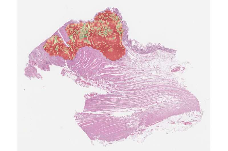 AI-based marker for colon cancer can help reduce over-and undertreatment of patients