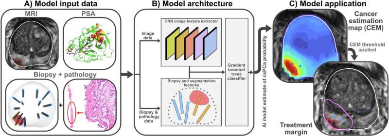 AI model could help improve outcomes of prostate cancer focal therapy