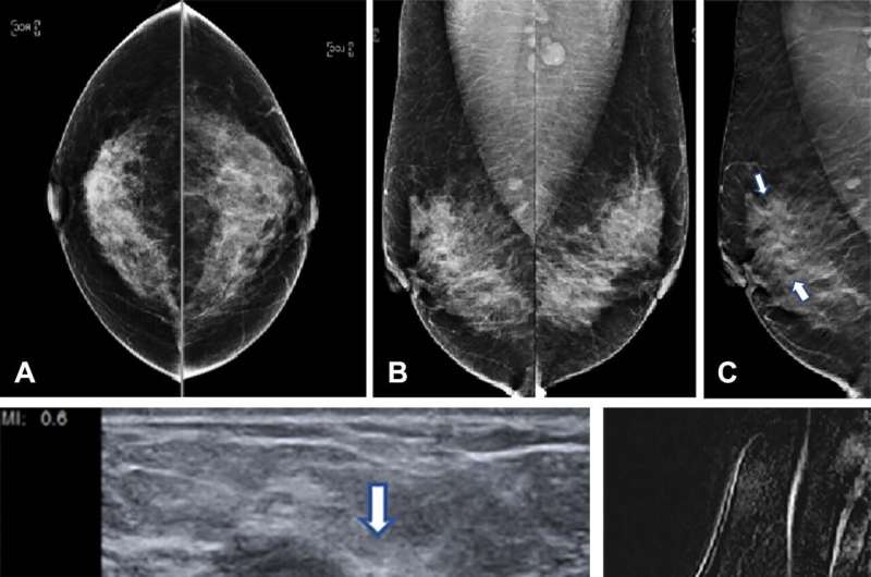 Huge study finds tomosynthesis better at breast cancer detection