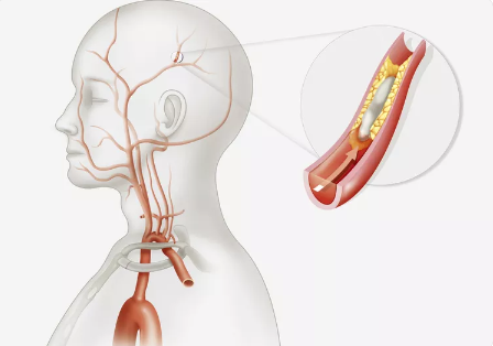 Causes and Effects of Thrombotic Stroke