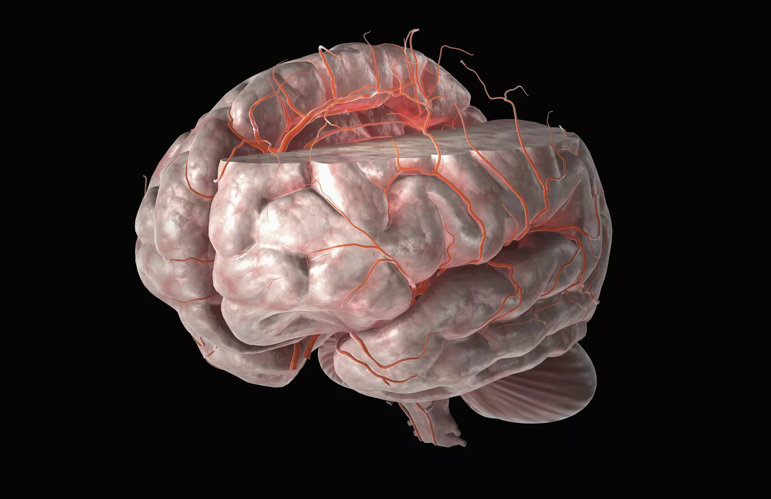 Middle Cerebral Artery Stroke Causes, Symptoms, and Treatment