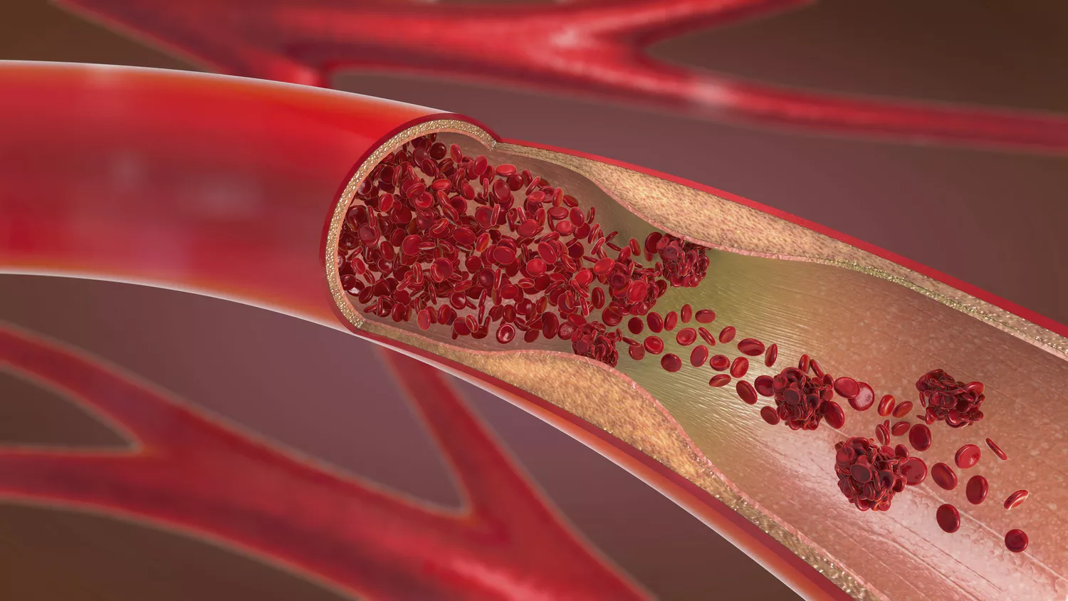 What Is Vascular Disease?