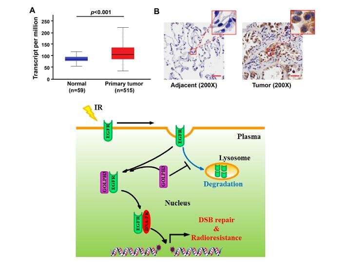 New mechanism of radioresistance formation proved in lung adenocarcinoma