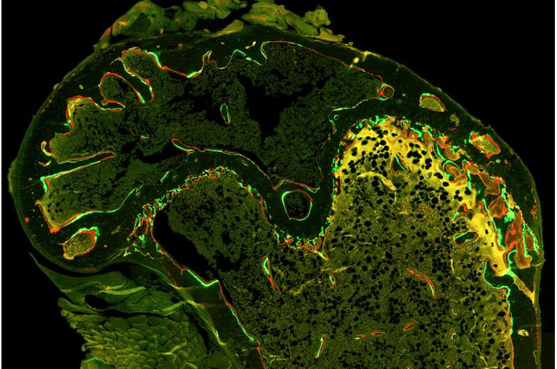 Investigational drugs block bone loss in mice receiving chemotherapy